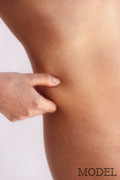 Liposuction | Power Assisted Liposuction | Manhattan | New York City